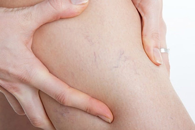 Nuevo método para estudiar los derrames de las piernas
